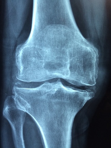 x-ray of a knee